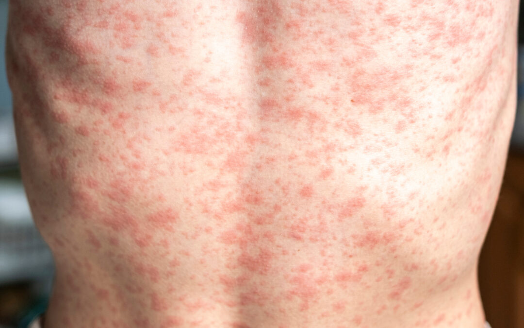 Aumento de casos de sarampión en Estados Unidos: Implicaciones para Nevada