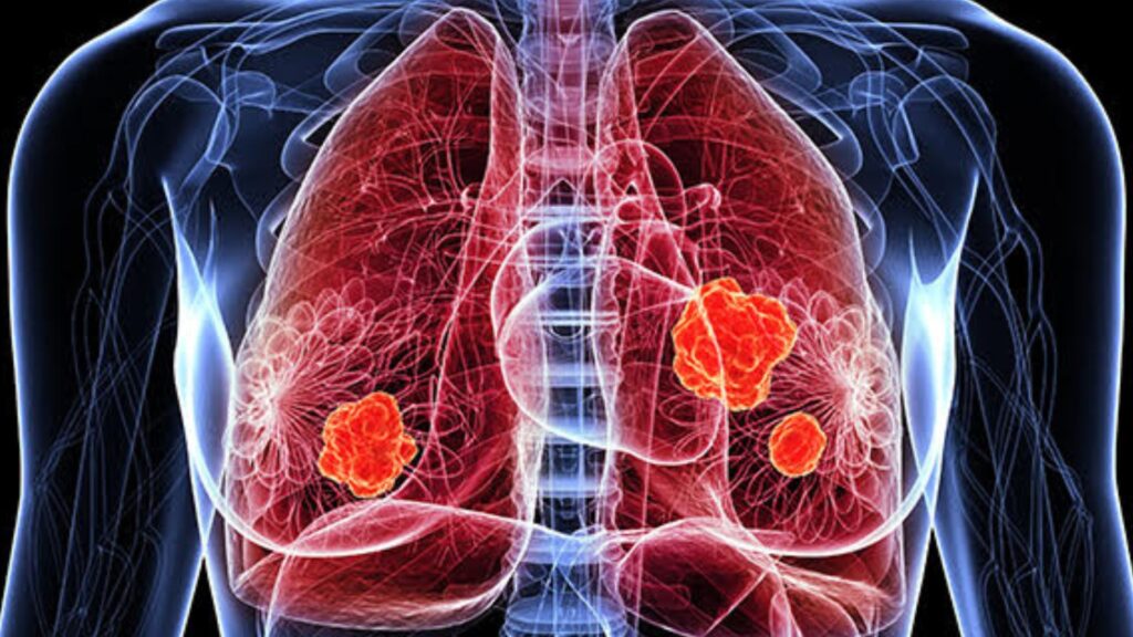 En el día mundial del pulmón expertos advierten sobre los riesgos del vape