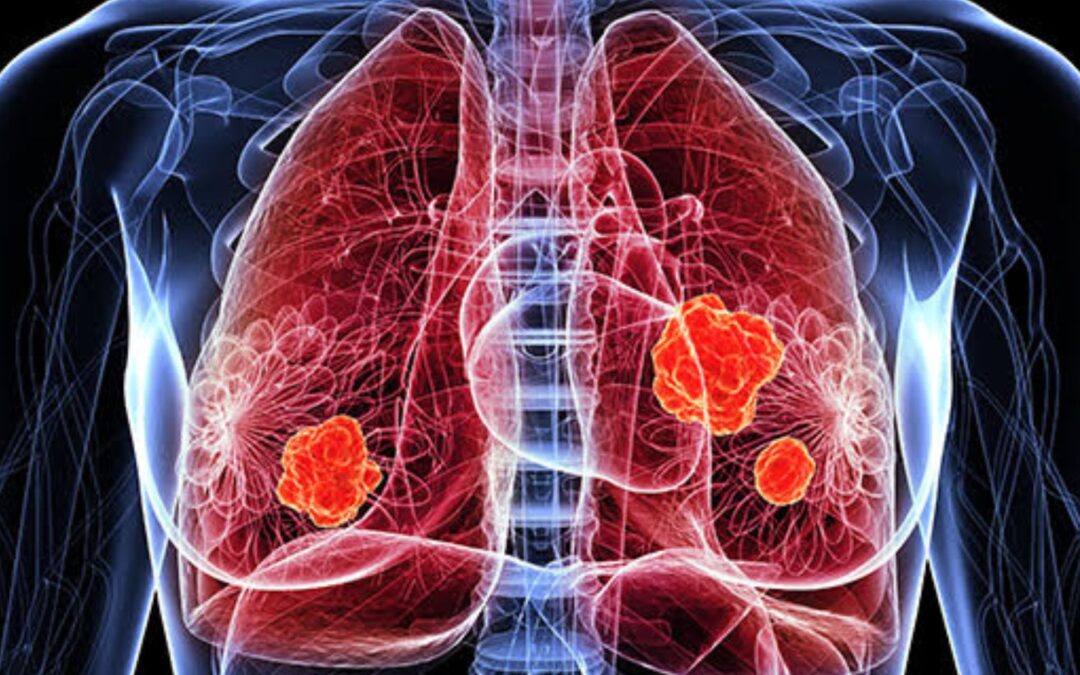 En el día mundial del pulmón expertos advierten sobre los riesgos del vape