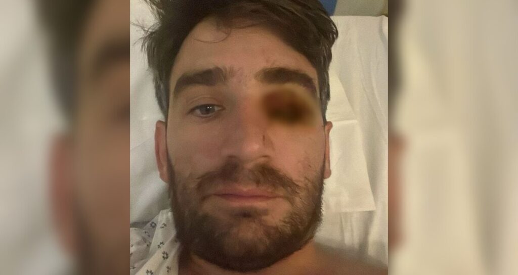 Accidente en Fiesta de Año Nuevo: Hombre Pierde un Ojo por Explosión de Fuegos Pirotécnicos