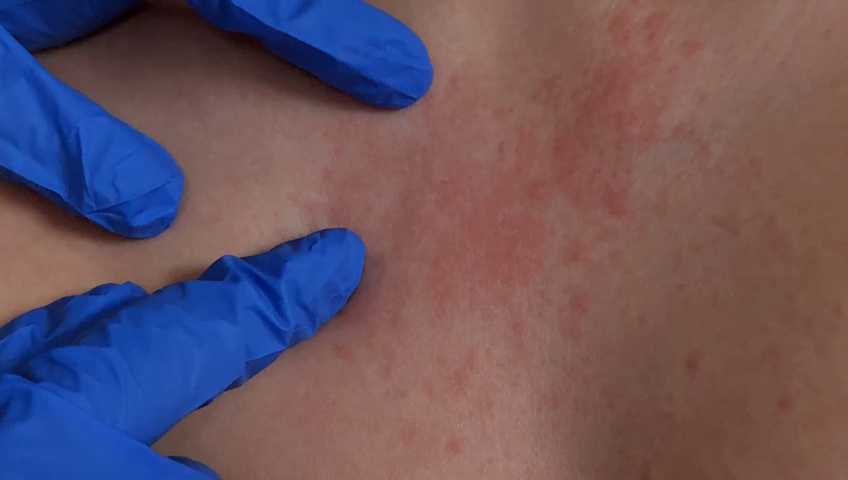 Alerta de salud: Casos de sarampión confirmados en Texas