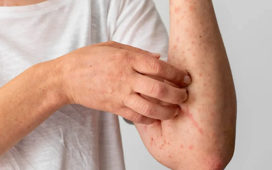 Guanajuato Registra 6 Nuevos Casos de Sarampión, Advierte la Secretaría de Salud