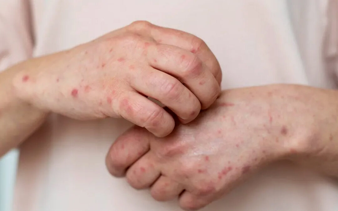 Aumento de casos de sarampión en Nuevo León: ya son 32 en 2026