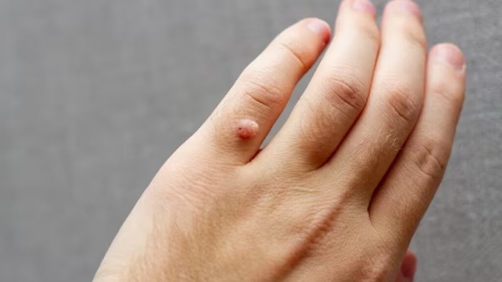 El VPH no siempre conduce al cáncer, aclara especialista