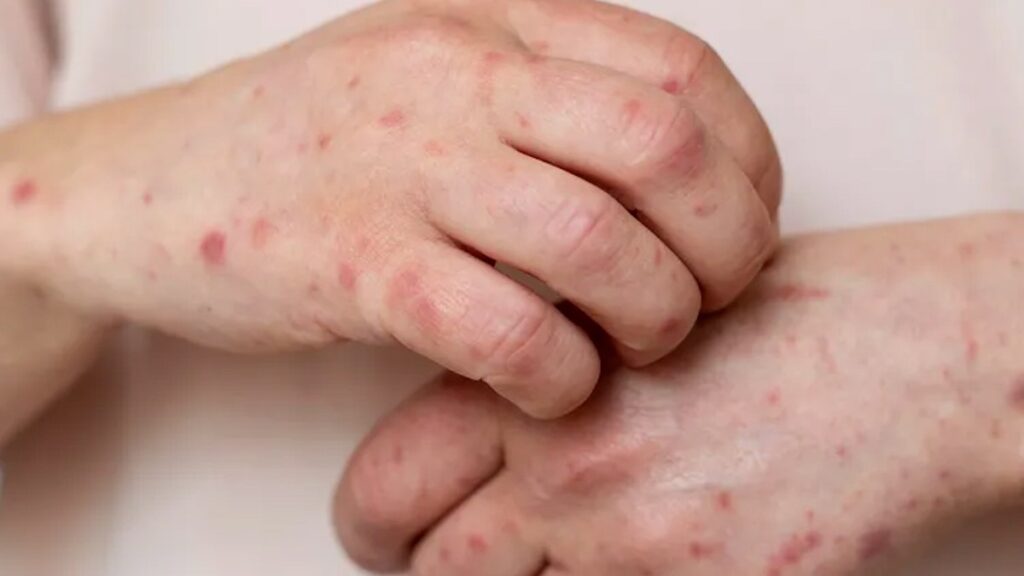 Alertan sobre brotes de sarampión en Torreón: 4 casos confirmados