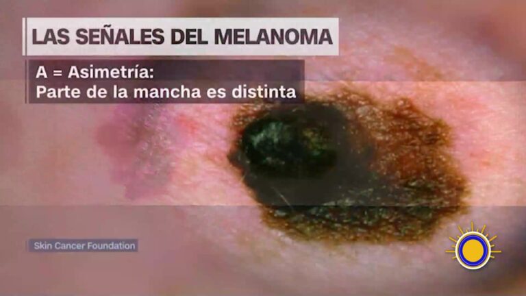 El Melanoma: El Cáncer De Piel Más Agresivo Y Cómo Detectarlo A Tiempo
