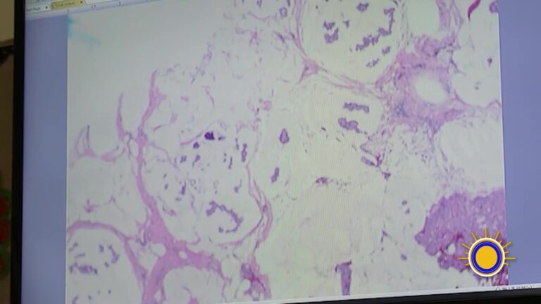 Avances En La Detección Del Cáncer De Ovario Usando Inteligencia Artificial
